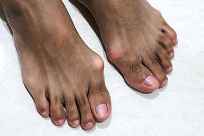 Bunion deformity on the big toe — bunion treatment in Centurion