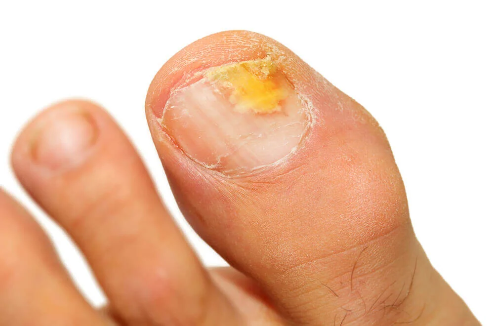 Toenail fungal infection — yellow thickened nail