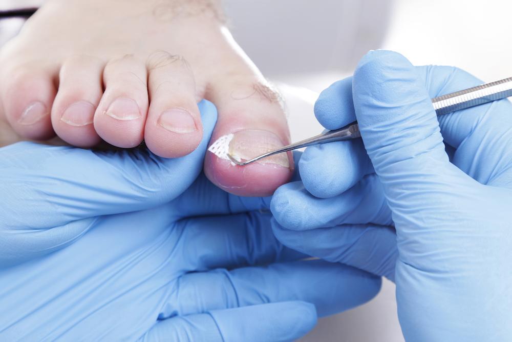 Ingrown toenail treatment
